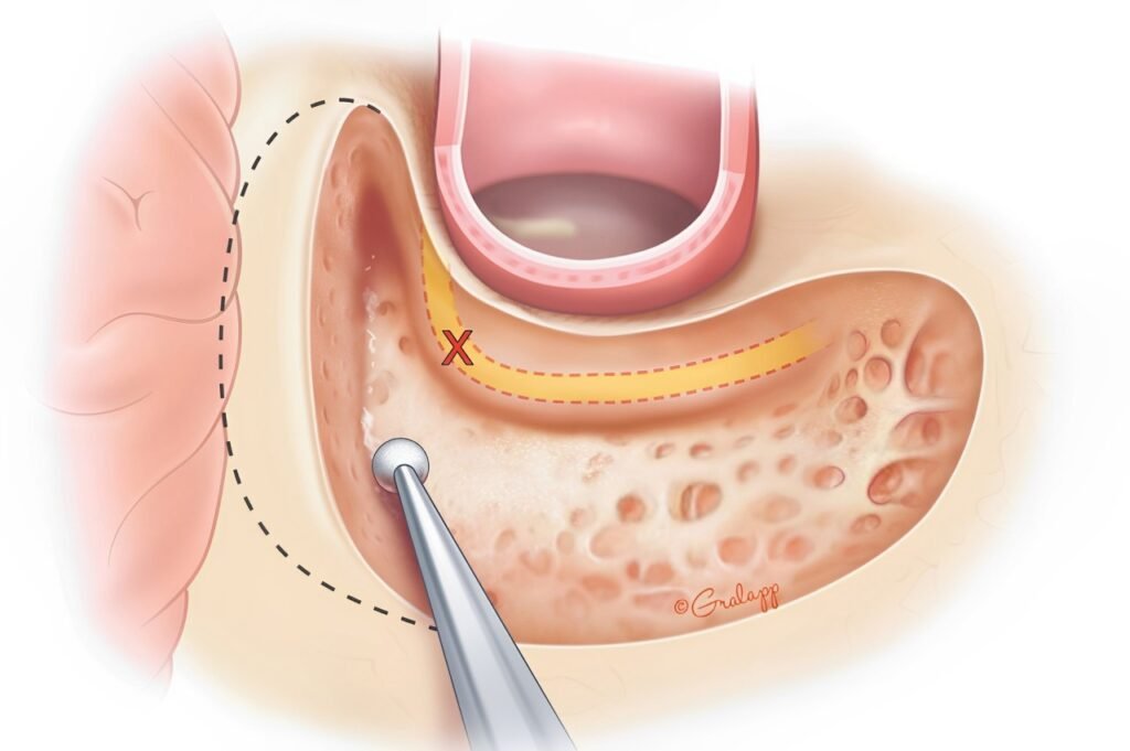 MICRO ENT Hospital - The best hospital for ear infection treatment in Tolichowki, offering expert care for a range of ear conditions.