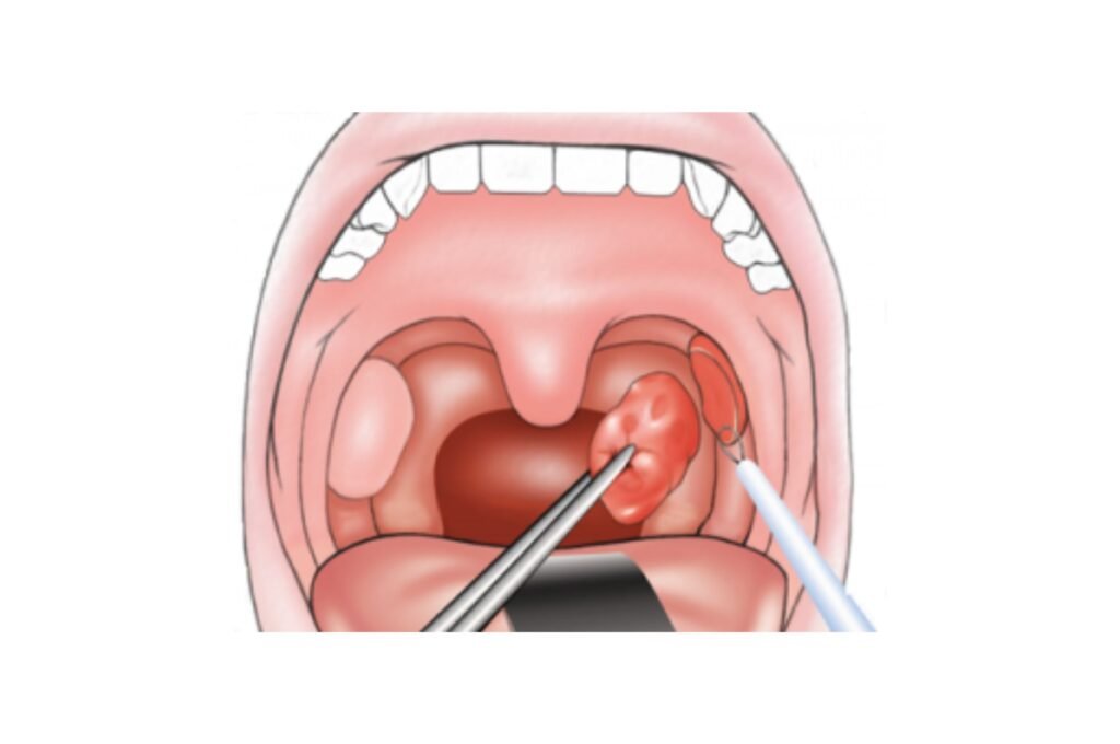 best throat treatment in tolichowki Hyderabad